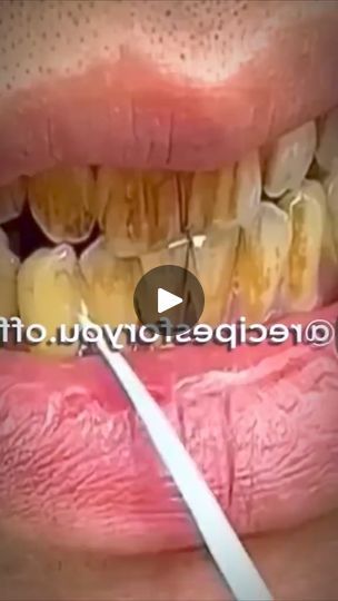 1K views · 30 reactions | Whiten your yellow teeth in just 2 minutes #teethwhitening #teethcare #remedy #naturalremedy
Healthy Tips | Healthy Tips | Healthy Tips · Original audio Yellow Teeth Remedy, Teeth Aesthetic, Teeth Remedies, Teeth Whitener, Whitening Teeth, Teeth Whitening Diy, Perfect Teeth, Whiten Teeth, Yellow Teeth