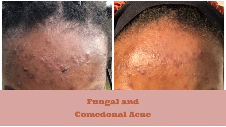 Skin diary on me trying to clear up my fungal and comedonal acne using benzoyl peroxide and salicylic acid. Malassezia Folliculitis Comedonal Acne, Fungal Acne, Forehead Acne, Benzoyl Peroxide, Acne Skin, Salicylic Acid, Acne Treatment, Beauty Skin, Things To Think About