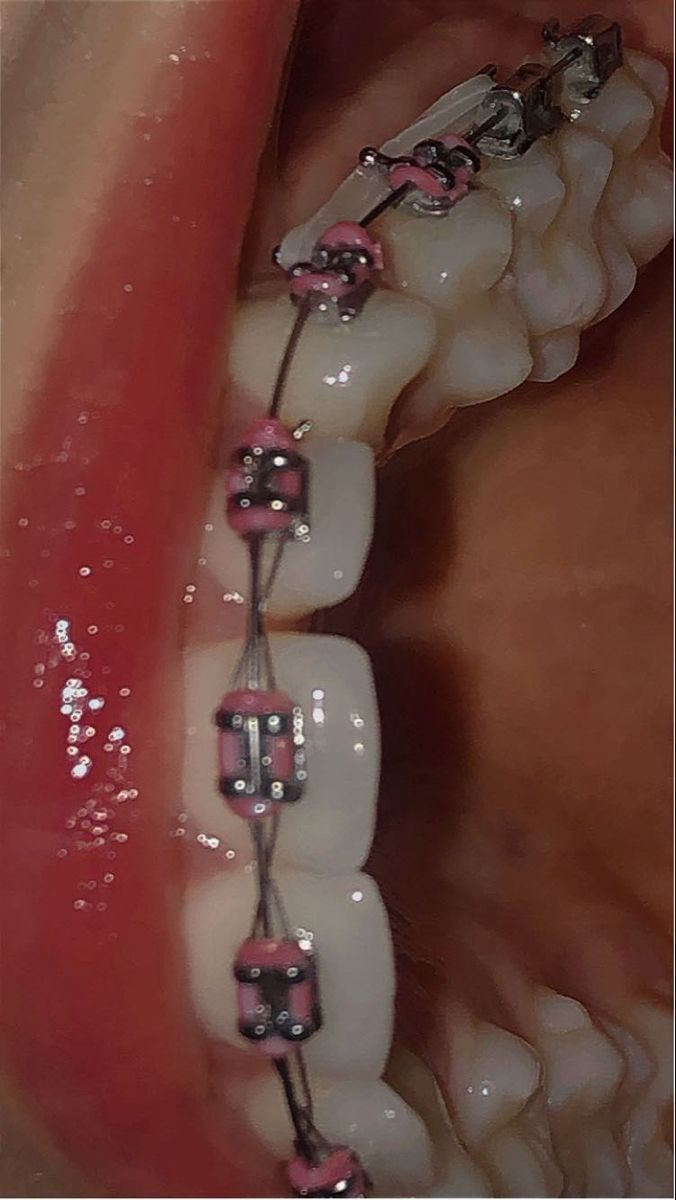 Perfect Teeth Braces, Brace Ideas, Dental Braces Colors, Pink Braces, Getting Braces, Brace Face, Band Ideas, Braces Colors, Dental Braces