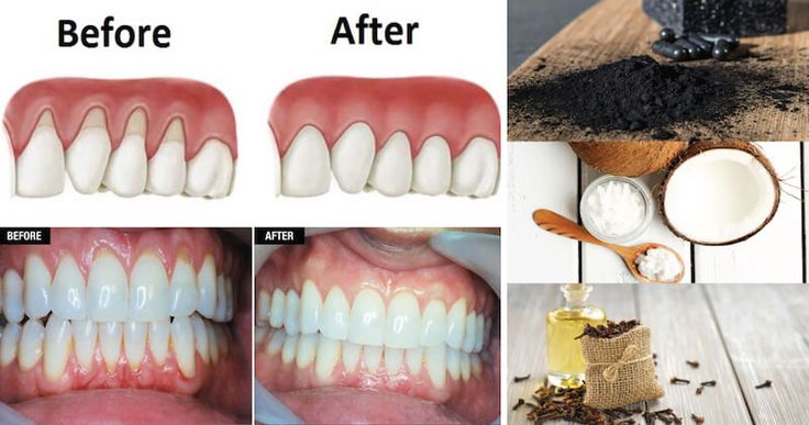 Do you suffer from receding gums? And if you do, did you know that there are many natural remedies that help grow back your receding gums in just a few weeks? Receding gums are basically just that – gums that have receded. It occurs when the gum tissues around your teeth wear away, and the Grow Back Receding Gums, Sensitive Teeth Remedy, Remedies For Tooth Ache, Swollen Gum, Gum Recession, Healthy Gums, Loose Tooth, Teeth Health, Tooth Pain