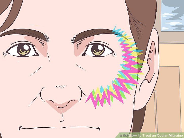 Visual Migraine Auras, Hairstyles For Migraines, Ocular Migraines Eyes, Optical Migraine, Occular Migraine, Migraine Types, Migraine Facts, Visual Migraine, Aura Migraine