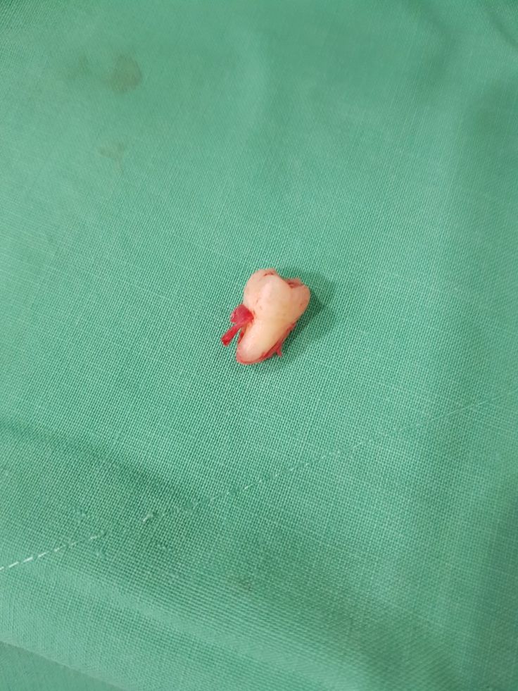 Wisdom tooth extraction. Next one is Monday. Decayed Tooth, Wishes Board, Tooth Extraction Healing, Tooth Implant, Wisdom Tooth Extraction, Wisdom Tooth, Dry Socket, Teeth Implants, Tooth Extraction