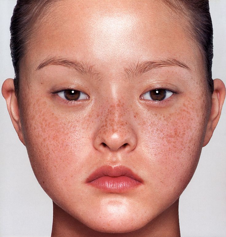 Getting Rid Of Freckles, Models Without Makeup, Brown Spots On Skin, Devon Aoki, Freckle Face, Brown Spots On Face, Nars Makeup, Skin Spots, Spots On Face