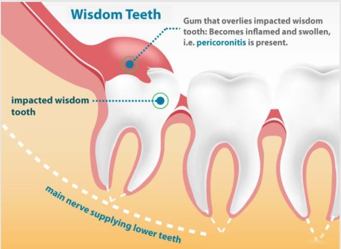 How do you make wisdom tooth pain go away? | Complete Dental Care Impacted Wisdom Teeth, Wisdom Teeth Pain, Tooth Extraction Aftercare, Teeth Surgery, Impacted Tooth, Sensitive Teeth Remedy, Wisdom Tooth Extraction, Wisdom Tooth, Kesehatan Gigi