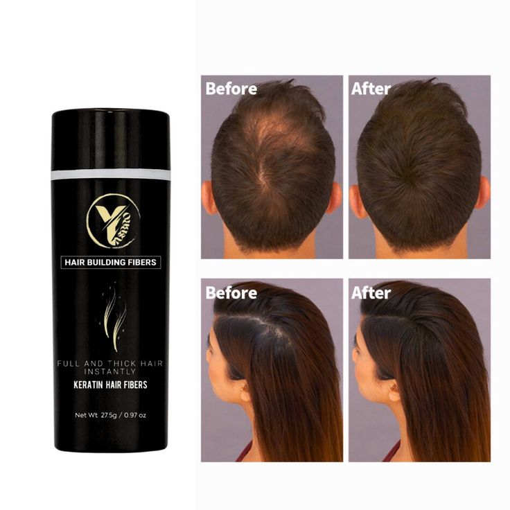 YASBRO KERATIN FIBRES is a breakthrough product for hair loss sufferers that:    1.  Instantly eliminates bald spots or appearance of thinning hair. Gives you a perfectly natural look. No one will know you're using YASBRO unless you tell them - even if they get a close-up view, outdoor, under bright sun light. Last all day, all night, through wind, rain and sweat. Will not smear or stain your skin or clothing. 2.  Works for both men and women. 3.  Unlike ordinary products on the mass market, YAS Protein Hair, Ordinary Products, Bald Spot, Hair Protein, Bald Hair, Bright Sun, Keratin Hair, Hair Cover, Hair Thickening