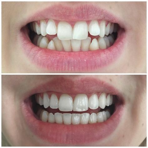 What a beautiful transformation 😃💜 #smilemakeover Sensitive Teeth Remedy, Dental Videos, Homemade Toothpaste, Heal Cavities, Veneers Teeth, Dental Art, Botox Injections, Best Teeth Whitening, Dental Surgery