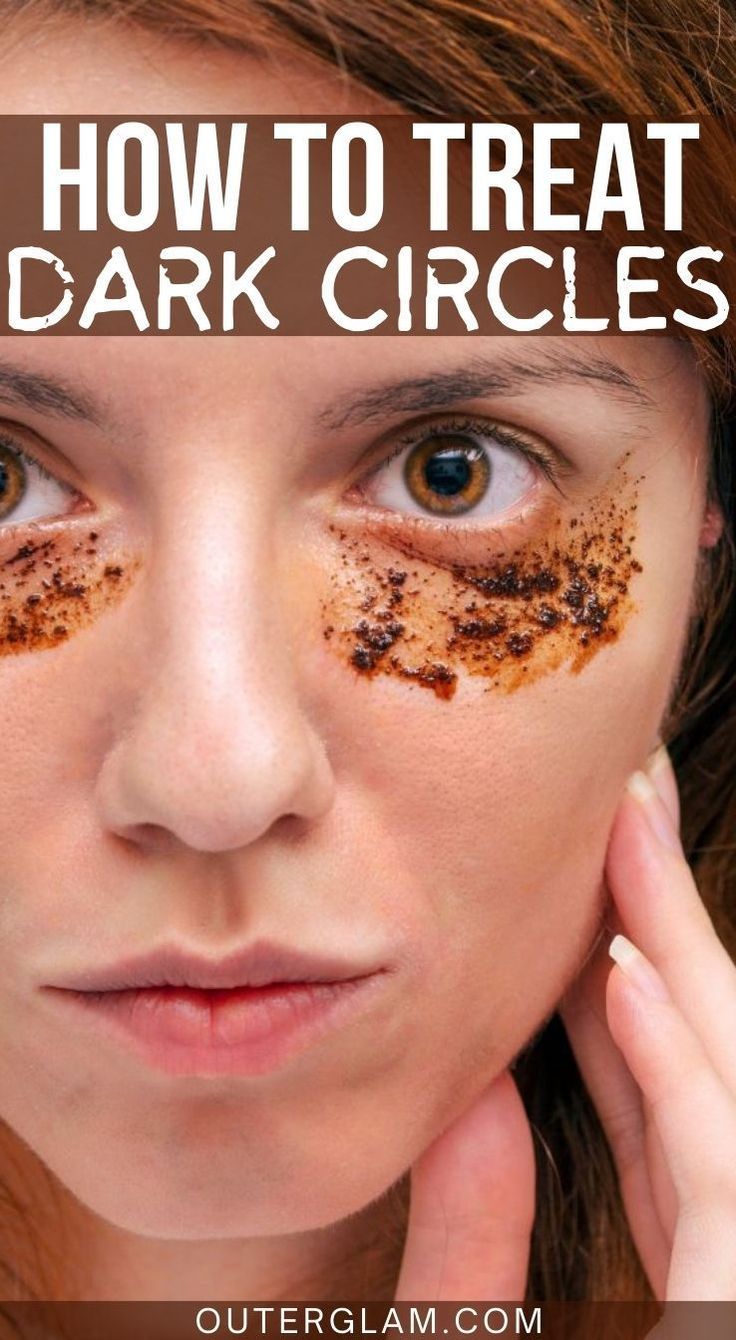 Whether you've battled with pesky dark circles for years or you've just noticed them creeping in, dealing with them can be a real challenge. If you're searching for effective solutions to banish those under-eye shadows and regain a fresh look, this article is for you. Dive into a comprehensive guide covering the causes of dark circles and a range of remedies to help you achieve brighter, healthier skin. Homemade Remedies For Dark Circles, Dark Eye Circles Remedies, Dark Circles Natural Remedy, Black Circles Under Eyes Remedies, Dark Circles Under The Eyes Remedies Natural Treatments, Dark Puffy Circles Under Eyes, Dark Eye Circles How To Get Rid Of, How To Get Rid Of Dark Circles Under Eye Naturally, How To Fix Dark Circles