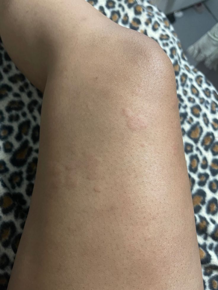 the back of a woman's arm with spots on it and her left leg