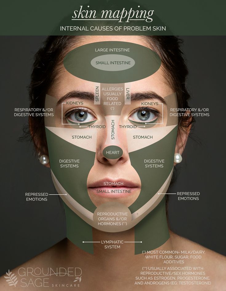 Acne Zones Face Mapping, Pimple On Face Reason, Location Of Pimples Meaning, Spot Face Map, Why Do I Get Pimples On My Chin, Spot Mapping Face, Breaking Out On Cheeks, Acne Location Meaning Face Mapping, Acne Causes On Face Chart