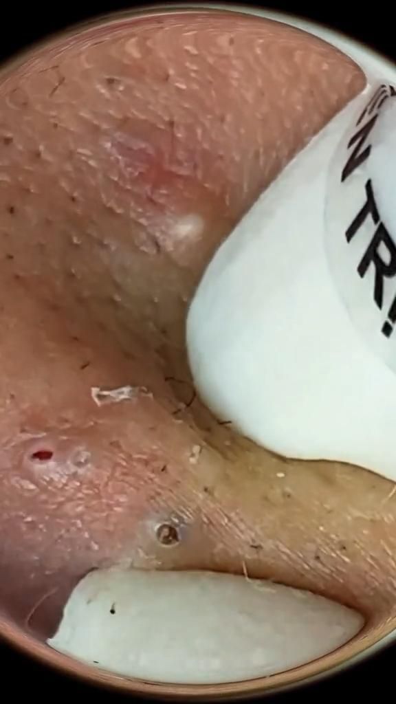 Watch satisfying #pimplepopping & #blackheadremoval videos that are guaranteed to make you cringe and say "ew!" #gross #popping #satisfying Blackheads Removal Satisfying Videos, Satisfying Black Head Removal Video, Black Head Removal Video Nose, Huge Blackheads, How To Treat Blackheads, Diy Pore Strips, Best Dark Spot Remover, Kelly Hair, Pimple Pop