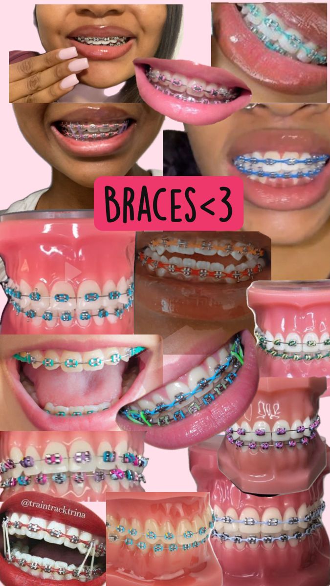 Dental Braces Colors, Braces Colors Combinations, Braces Ideas, Pink Braces, Kawat Gigi, Estilo Chola, Cute Braces Colors, Pretty Teeth, Braces Tips