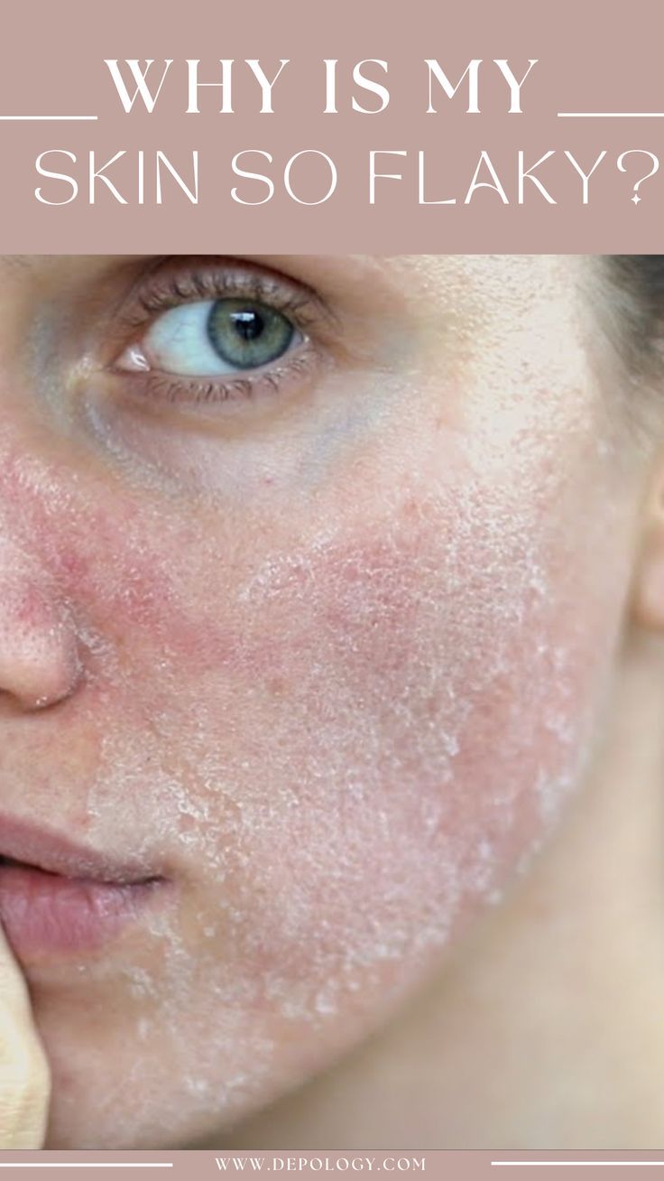 There is often a specific reason for those who see these symptoms. Getting down to the root of the issue is the first step to ensuring you are able to either treat or maintain your skin concerns, no longer thinking about them on a daily. Extremely Dry Face, Flaky Skin On Face, Dry Skin Home Remedies, Self Consciousness, Super Dry Skin, Severe Dry Skin, Type Of Skin, Flaking Skin, Extremely Dry Skin