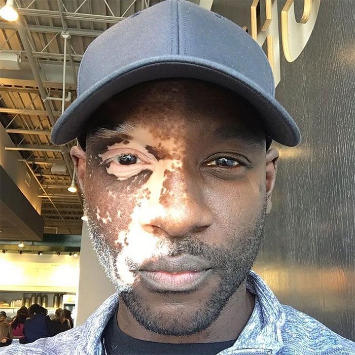 a man wearing a baseball cap and sunburn on his face