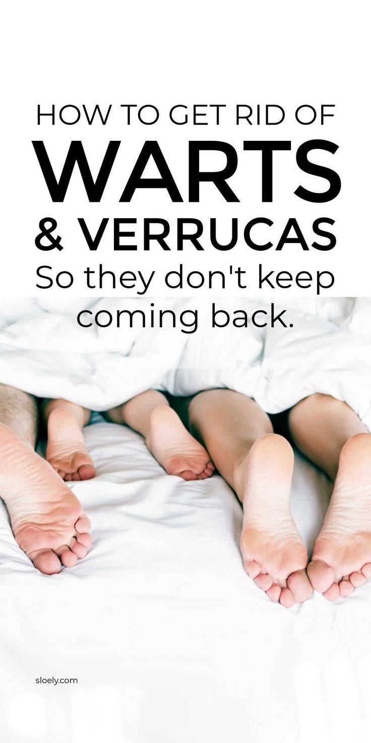 Learn how to get rid of warts and verrucas so they don't come back. These simple home remedies remove warts and verrucas and prevent them returning. #getridofwarts #warts #wartremedy #removewarts How To Treat Warts, Verruca Removal, Flat Warts, Plantar Warts, Don't Come Back, Home Remedies For Warts, Remove Skin Tags Naturally, Warts Remedy, Remove Warts