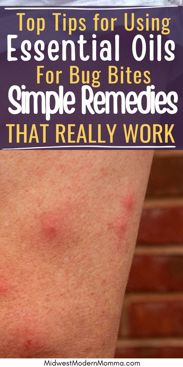 Essential oil remedies for bug bites showing red, irritated skin on an arm. Itchy Bug Bite Remedy, Natural Bug Bite Remedy, Bug Bite Swelling, Essential Oils For Bug Bites, Oils For Bug Bites, Essential Oils Bug Bites, Bug Bite Itch Relief, Swelling Remedies, Essential Oil Remedies