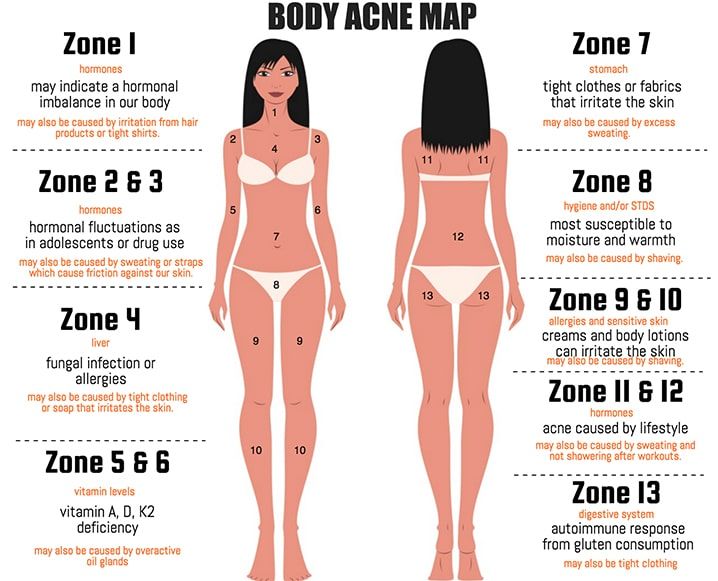 The Acne Map: What's The Meaning Behind Your Body Breakouts? - The Chalkboard Body Acne Map, Acne Map, Doterra Acne, Gesicht Mapping, Chest Acne, Face Mapping Acne, Face Mapping, Natural Acne, Body Acne