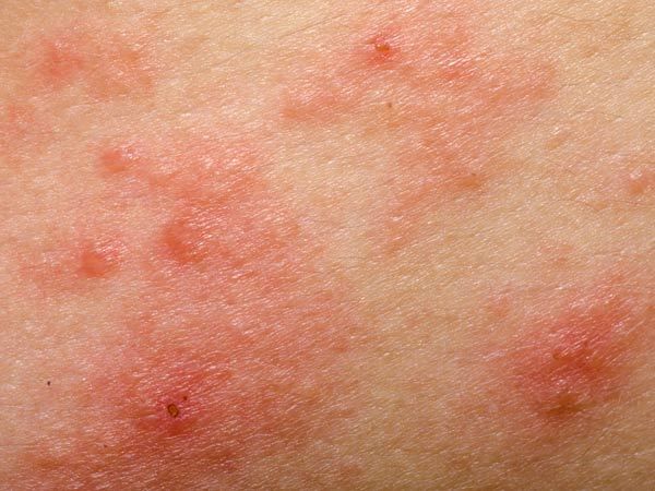 How To Deal With Eczema? Itchy Rash, Skin Allergies, Itchy Skin, Natural Treatments, Omega 3, Home Remedies, Natural Remedies, Aloe Vera, Acne