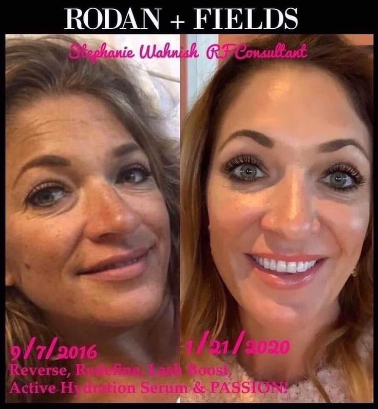 Karen Gates on Twitter: "✨💥✨Just Another 𝑺𝒕𝒖𝒏𝒏𝒊𝒏𝒈 𝑻𝒐𝒖𝒄𝒉𝒅𝒐𝒘𝒏 Before & After Picture of My Friend Stephanie Using 𝑹𝒐𝒅𝒂𝒏 + 𝑭𝒊𝒆𝒍𝒅𝒔 𝑺𝒌𝒊𝒏𝒄𝒂𝒓𝒆‼️ ❤️Love How she is 𝑨𝒈𝒊𝒏𝒈 𝑩𝒂𝒄𝒌𝒘𝒂𝒓𝒅𝒔!! 🗣Message Me and Let’s Chat about Creating Your Own Before and After Photos❣️… https://t.co/LxgkNblqYz" Rodan And Fields Consultant, Aging Backwards, Mole Removal, Winning Products, Premium Skincare, Skin Discoloration, Sun Damage, Rodan And Fields, Age Spots