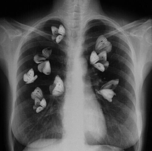 an x - ray shows butterflies on the chest and in the upper right hand corner