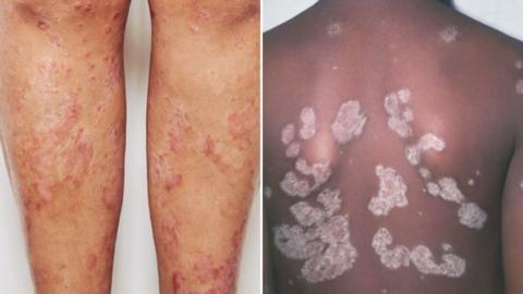 An image of legs and a back with psoriasis