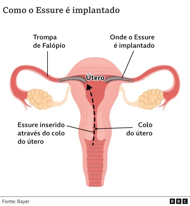 gráfico mostra como essure é implantado