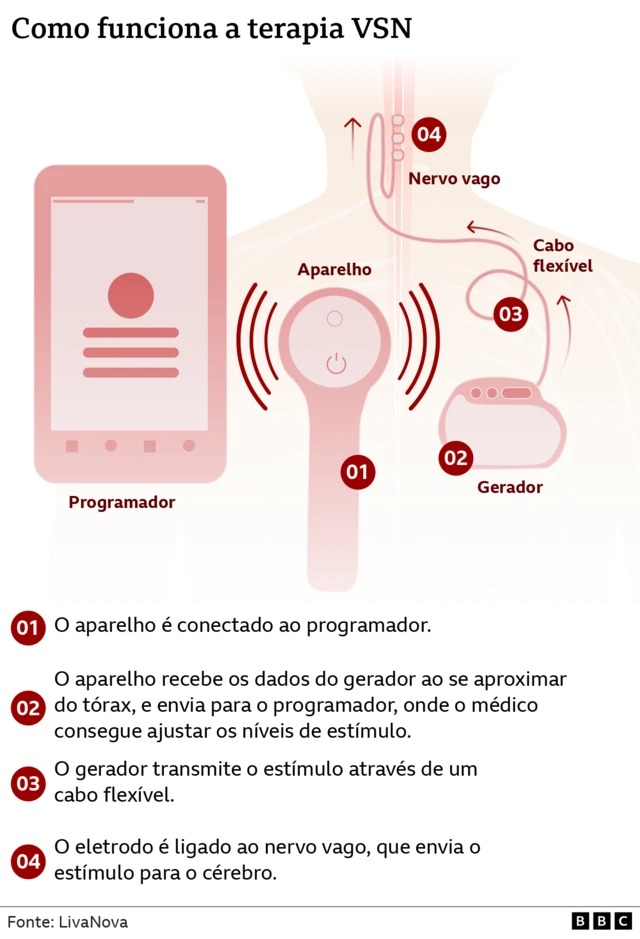 Ilustração mostra como funciona o impante no corpo