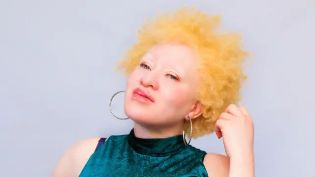 Regina Mary Ndlodvu é uma mulher com albinismo