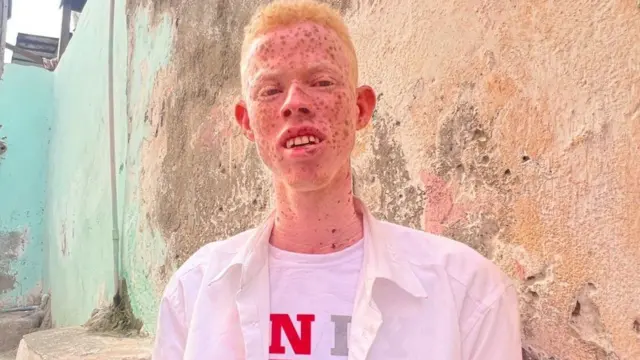 Homem albino