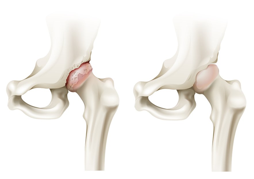 Osteoartritis kolka.