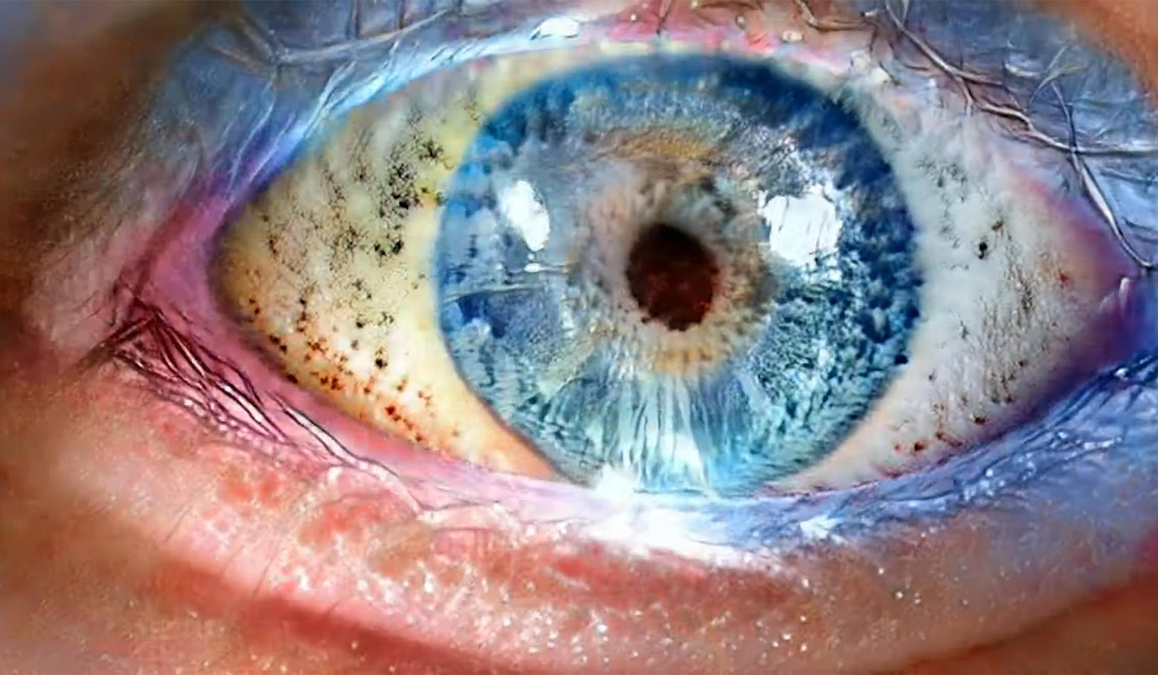 Close-up photo of a blue eye with detailed iris patterns, visible blood vessels and reflections on the cornea.