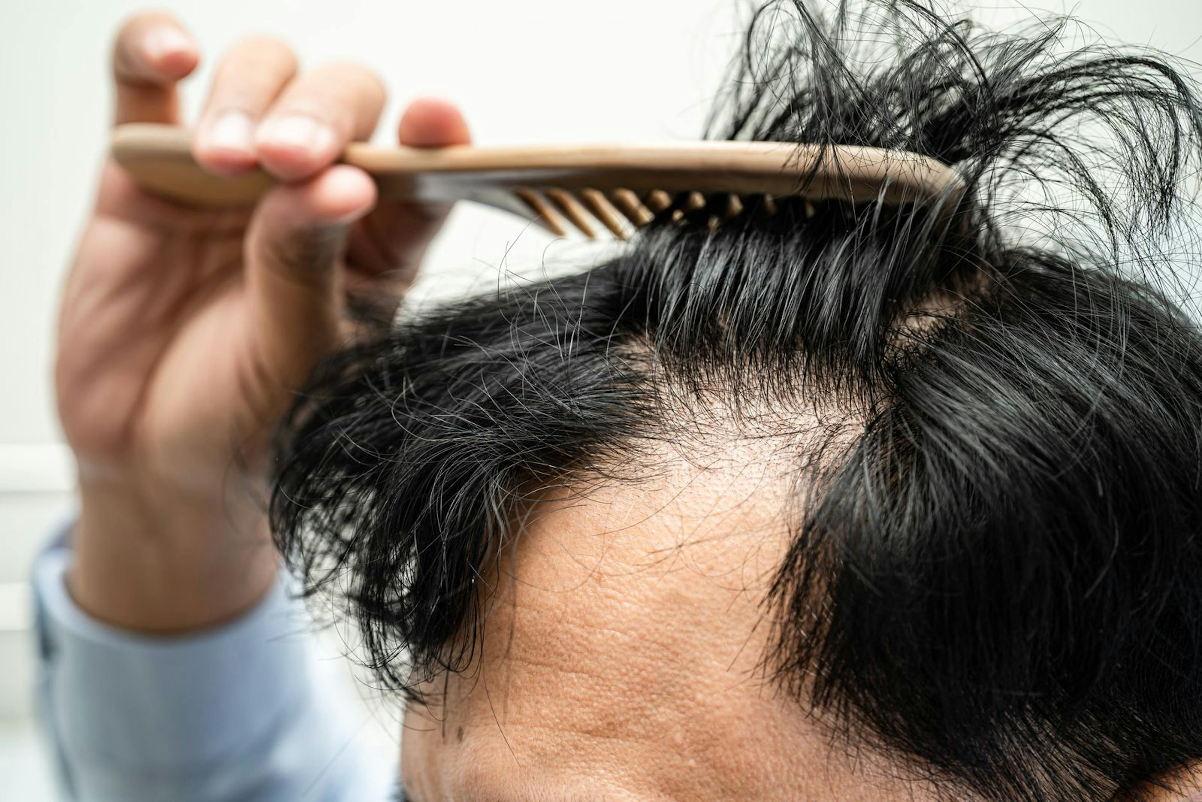 Genetic prediction of male pattern baldness