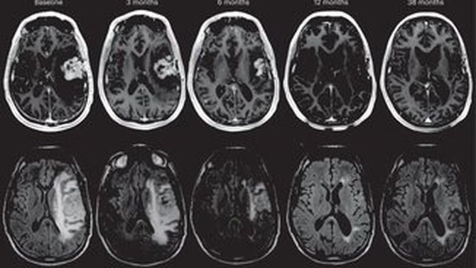 Glioblastoma, un dels tumors més agressius i difícils de tractar. Font: Nassiri et al., Nature Medicine 2023