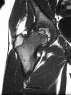 Skeletal sickle cell anemia. Osteonecrosis. Corona