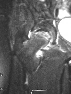 Skeletal sickle cell anemia. Osteonecrosis in the 