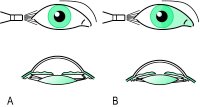 Fig. T11 Two different widths of the angle of the anterior chamber