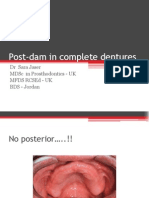 Post-Dam in Complete Dentures