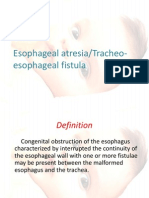 Esophageal Atresia