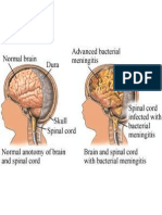 Bacterial Meningitis in Children