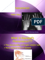 Raynaud's Phenomenon: Helen Kline