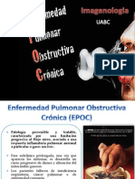 EPOC Enfermedad Pulmonar Obstructiva Cronica