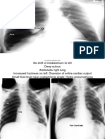 X-Rays of Chest