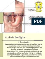 Acalasia Esofagica