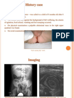 Intussusception