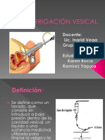 Irrigación Vesical