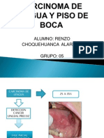 Carcinoma de Lengua y Piso de Boca