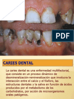 Caries Dental