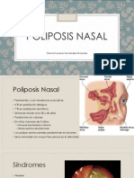 Poliposis Nasal