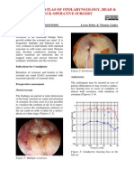 Canalplasty For Exostosis