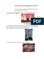 Técnica de Colocación Del Endoposte Prefabricado de Fibra de Vidrio y Preparacion