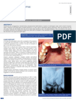 Erupted Odontoma: A Case Report: Abst T